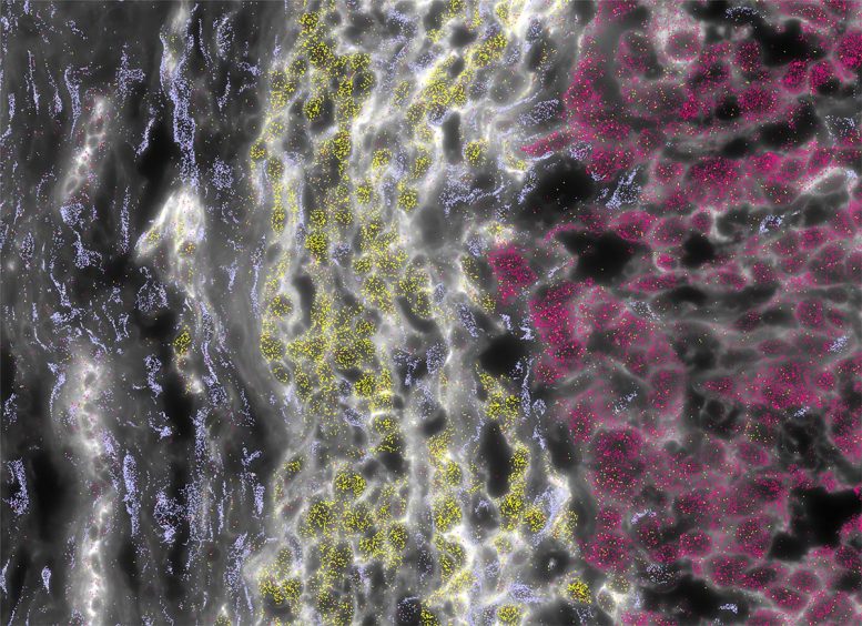 FLC Tumor