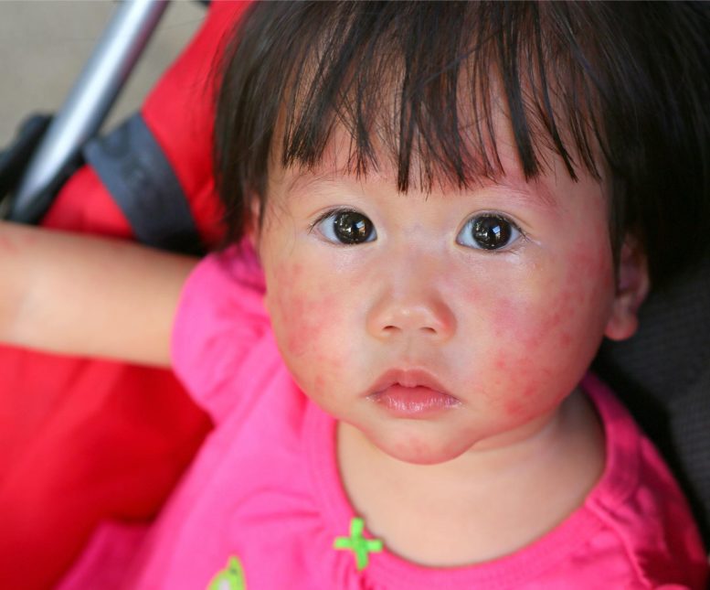 Face Rash Eczema Young Child