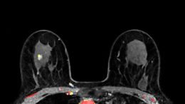 False Positive Breast Cancer MRI