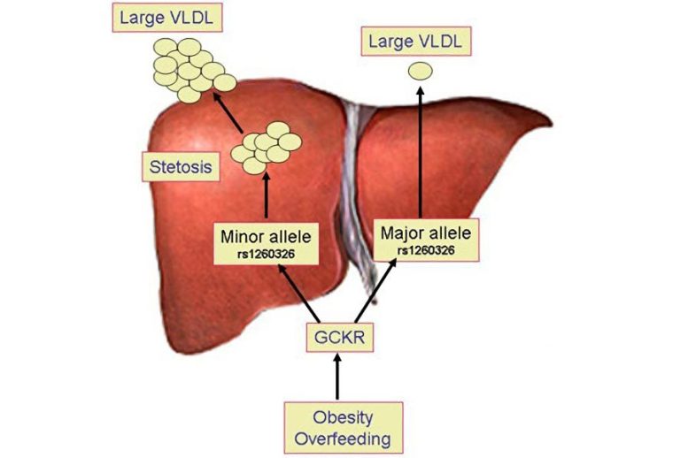 Fatty Liver Obesity