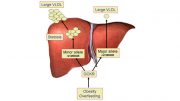 Fatty liver in obesity