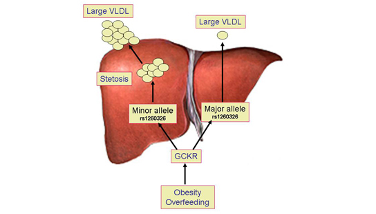 Fatty liver in obesity