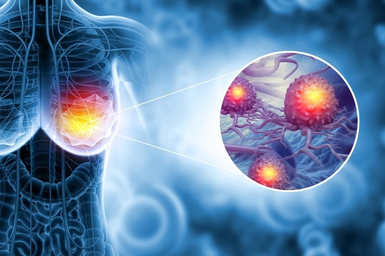 Scientists Find a New Way To Stop Aggressive Breast Cancer From Spreading