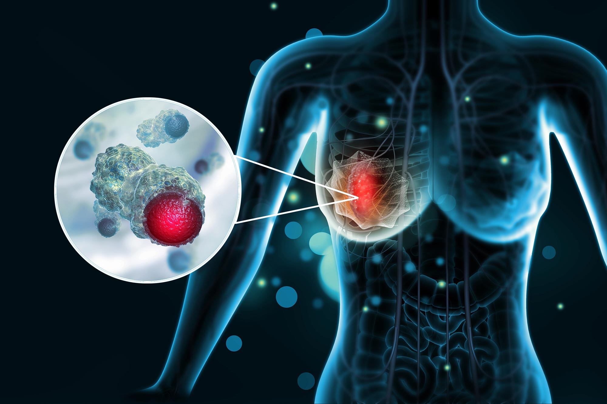 Scientists May Have Found a Way to Stop One of the Deadliest Breast Cancers
