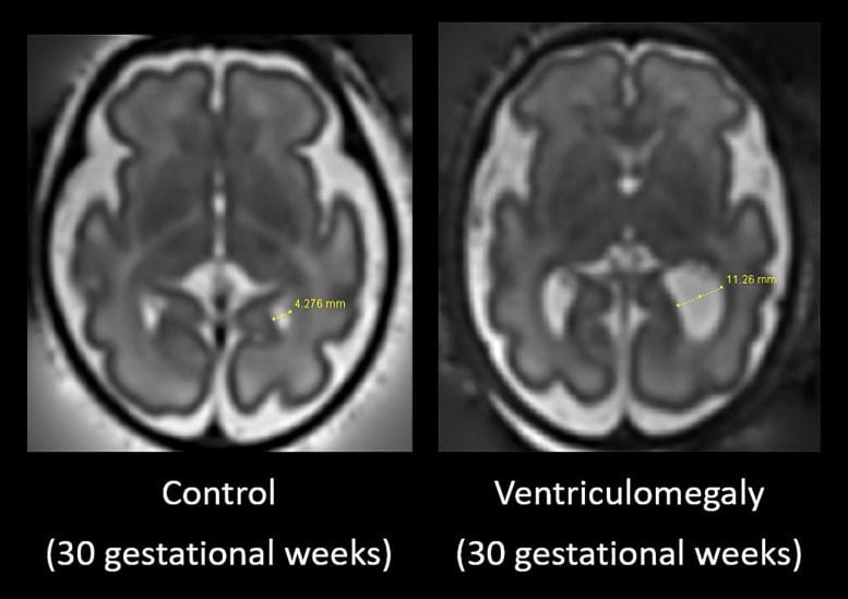 Fetal Brain Scan Early Indicators of Autism