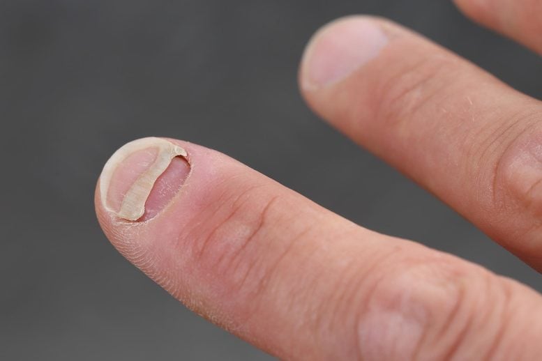 Fingernail Detachment