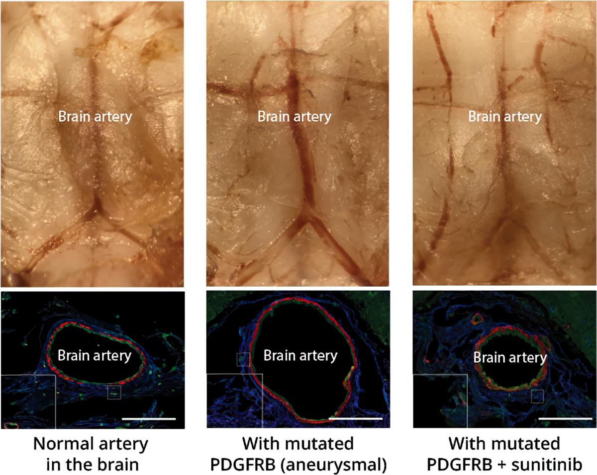 Intracranial Intrigue: Unmasking the Mutant Genes Behind Brain Aneurysms - Vimarsana News