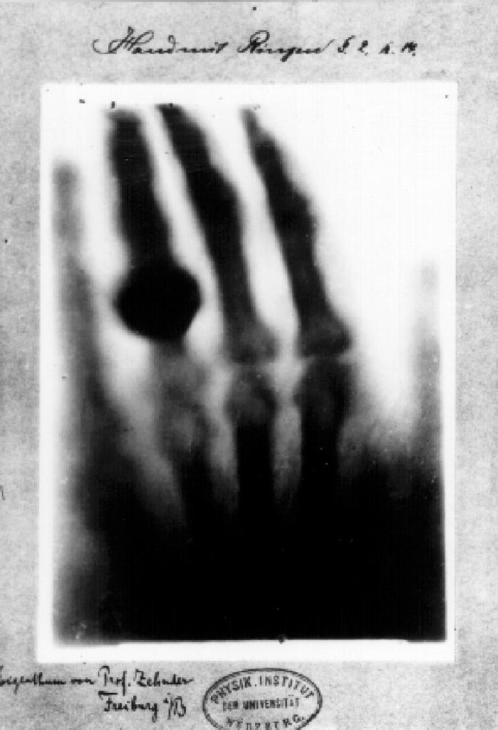 First Medical X-Ray by Wilhelm Röntgen