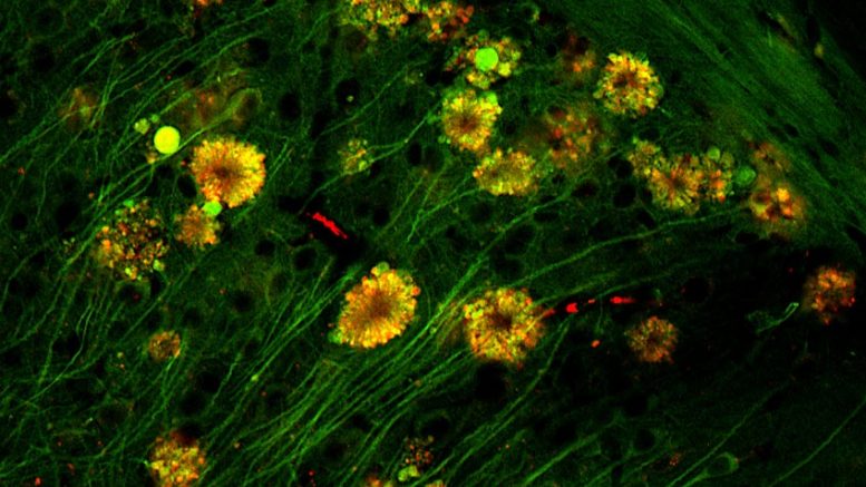 Formazioni floreali di vacuoli autofagici nei neuroni della malattia di Alzheimer