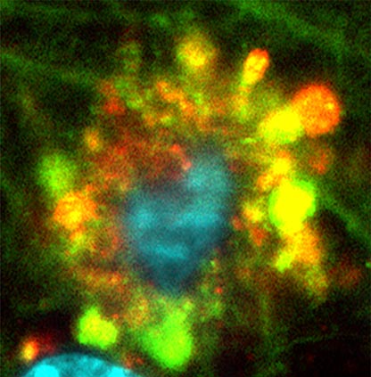 Formazioni floreali di vacuoli autofagici nei neuroni del morbo di Alzheimer ad alta risoluzione
