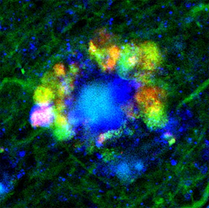 Formazioni floreali di vacuoli autofagici nei neuroni del morbo di Alzheimer a risoluzione media