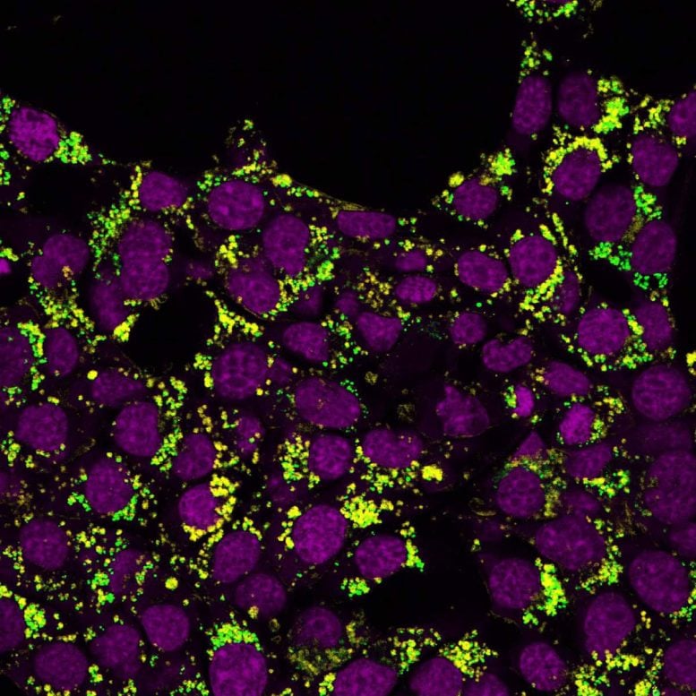 Fluorescent Cholesterol Signals in Cancer Cells
