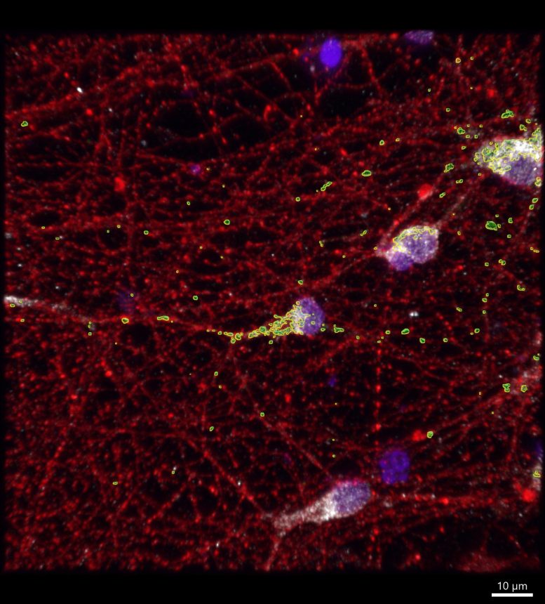 Neuroni della sindrome X fragile