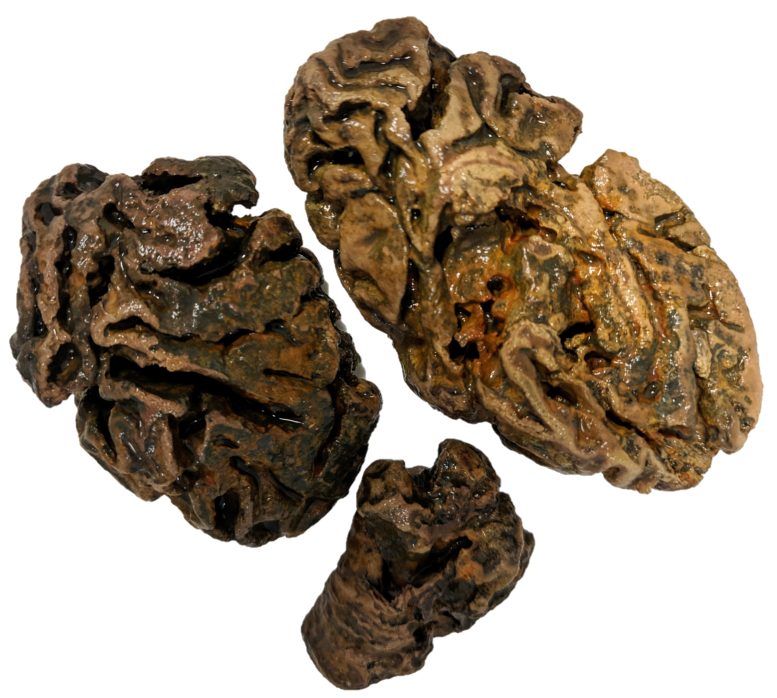 Fragments of Brain From an Individual Buried in a Victorian Workhouse Cemetery