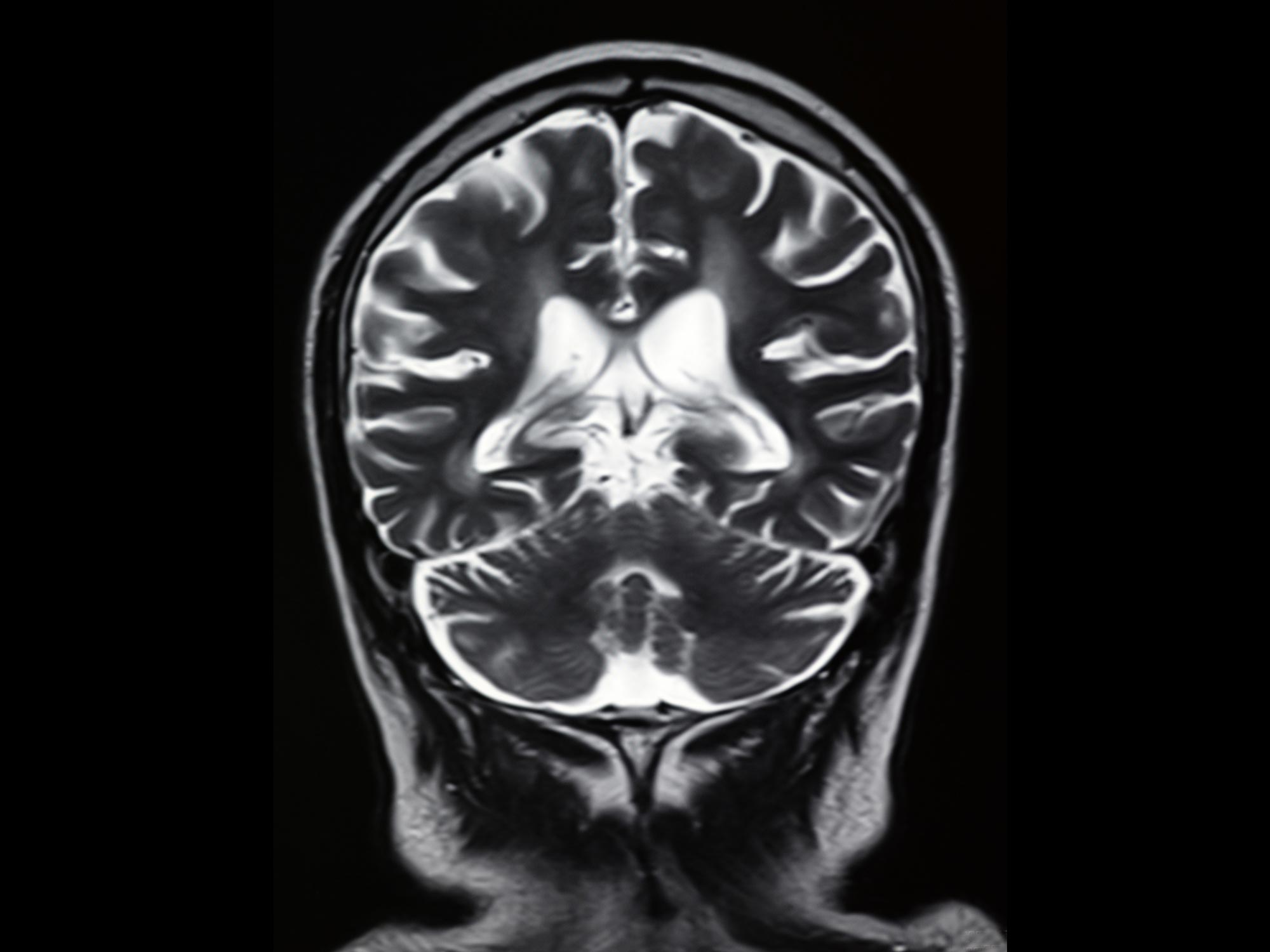 前面脳スキャン MRI 画像