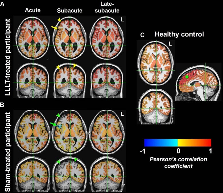 מפות מוח MRI פונקציונליות של קישוריות פונקציונלית במצב מנוחה