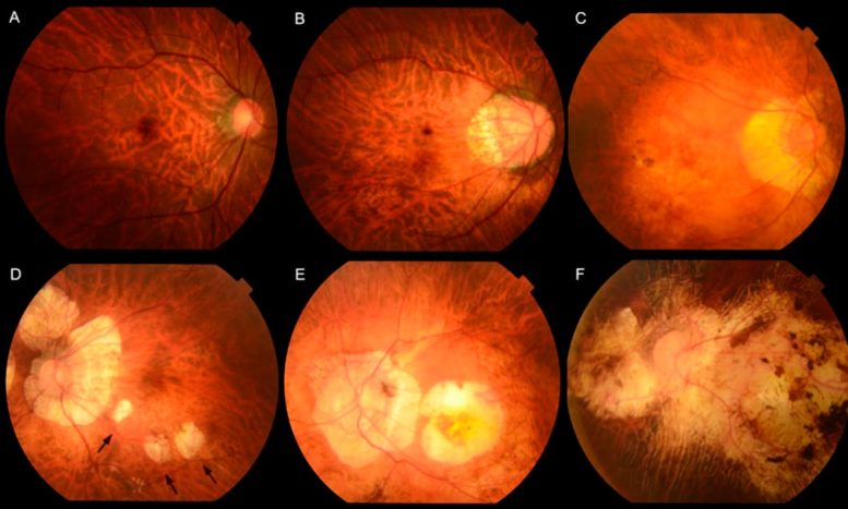 Fundus Photographs Showing Different Types of Myopic Maculopathy