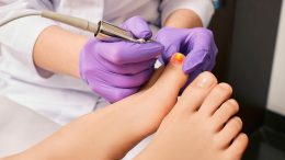 Fungal Toe Nail Infection Laser Treatment Crop