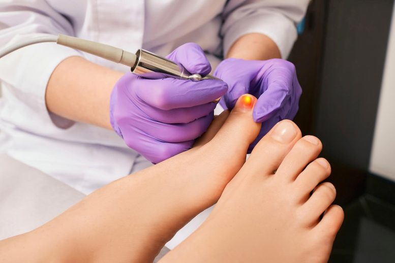 Fungal Toe Nail Infection Laser Treatment Crop