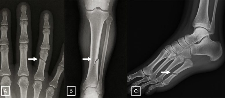 GPT-4o-Generated X-Rays of Fractures