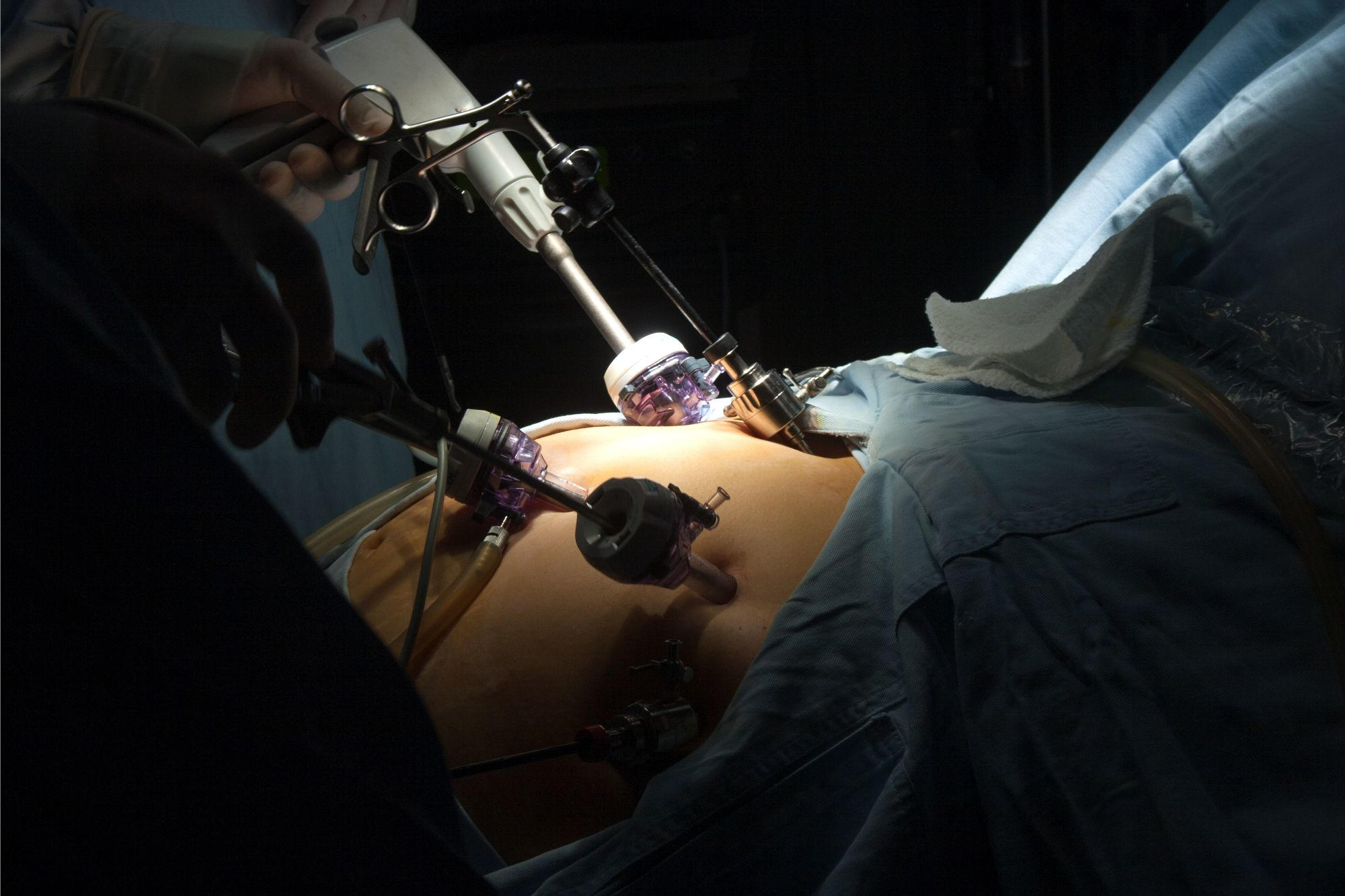 New Study Raises Questions About the Efficacy of Gastric Bypass Surgery - Vimarsana News