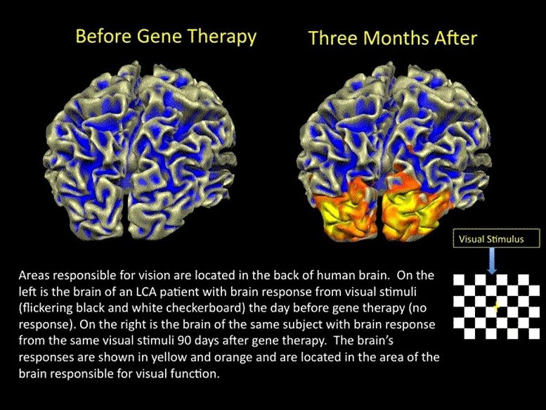 Gene Therapy Improves Eye Function
