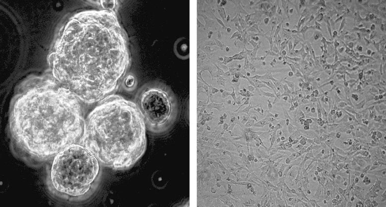 Aggregazione di cellule di glioblastoma con e senza niacina