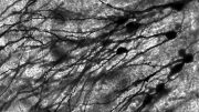 Golgi Stained Neurons in Dentate Gyrus of Epilepsy Patient
