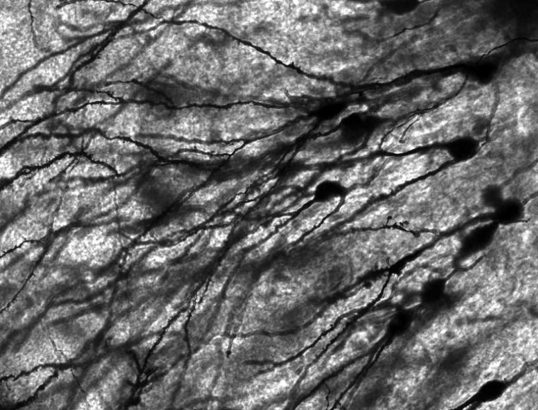 Golgi Stained Neurons in Dentate Gyrus of Epilepsy Patient