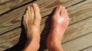 Gout Swollen Feet