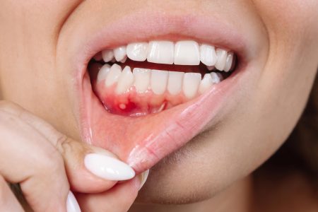 Poor Oral Health Linked to Hidden Brain Damage