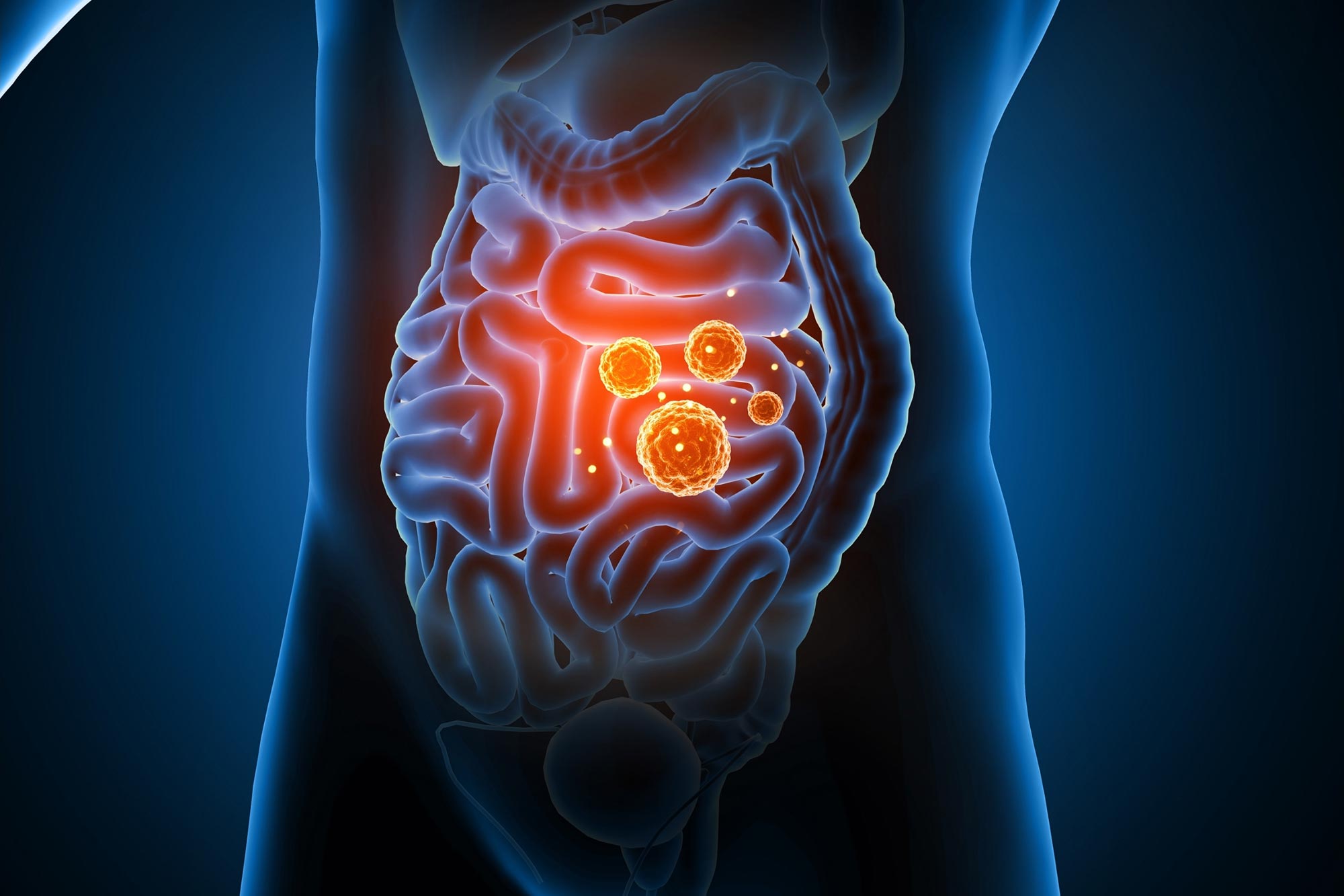 Gut Infection Microbes Illustration