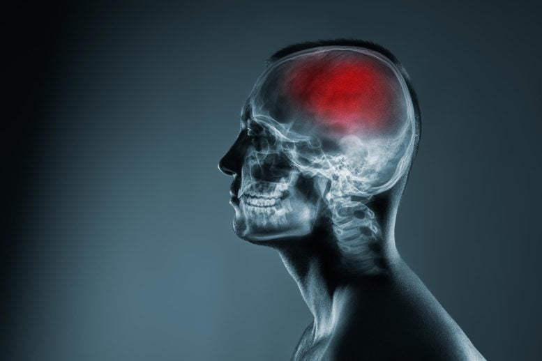 Head X-Ray Cerebral Stroke Brain Damage