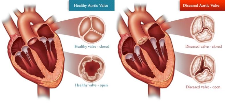 Heart Aortic Valve Disease