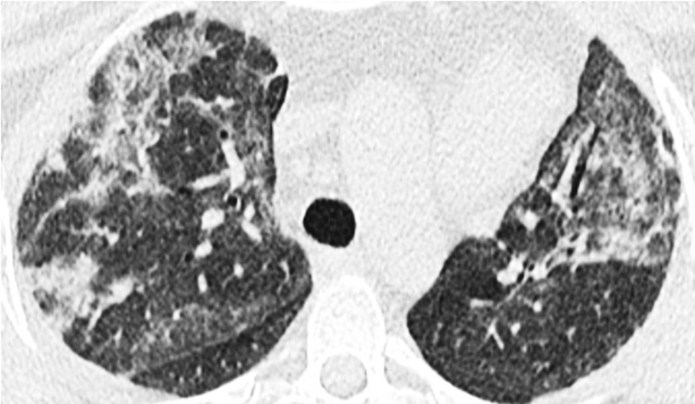 High Resolution Computed Tomography of the Lungs of a Patient With a Fatal Case of MDA5 Autoimmunity and Interstitial Pneumonitis Contemporaneous