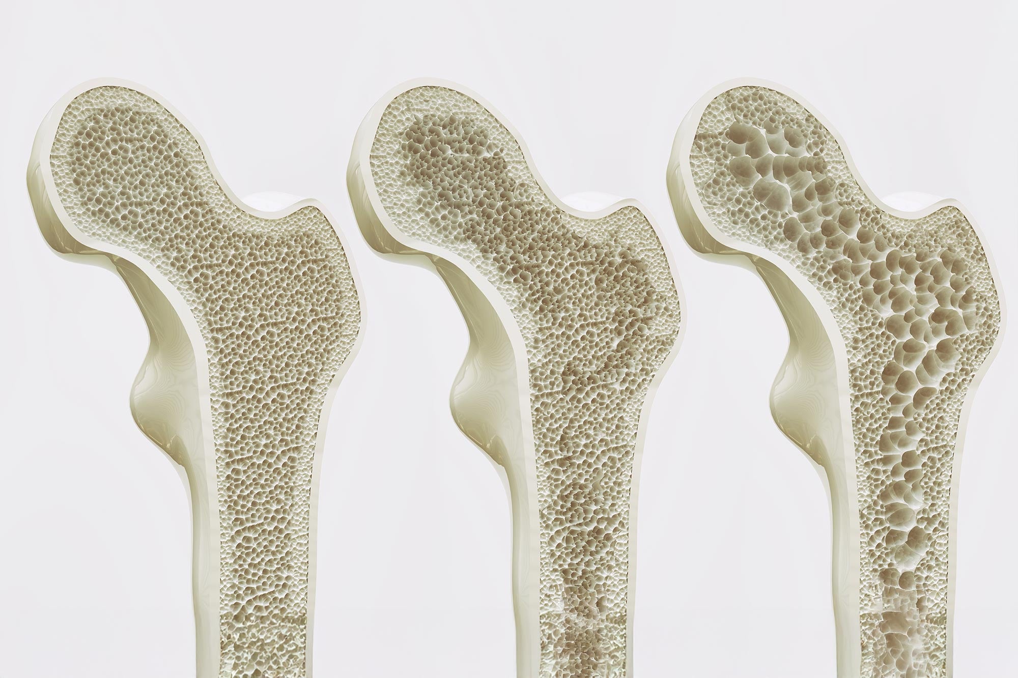 Breakthrough Bone Discovery Could Lead To “Exercise-in-a-Pill” for Osteoporosis - SciTechDaily