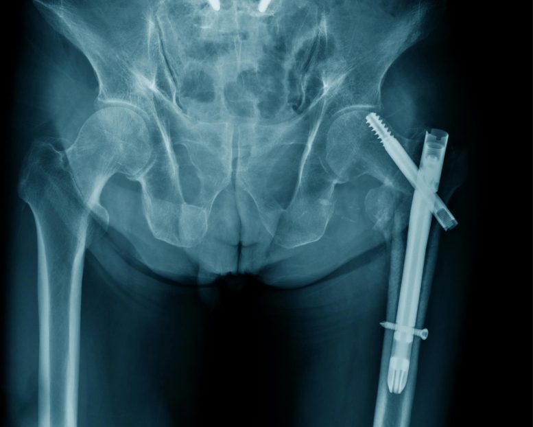 Hip Fixation Bone Fracture