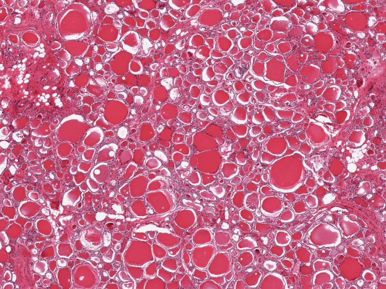 Histological Image of a Thyroid Tissue Sample Obtained From the GTEx Portal