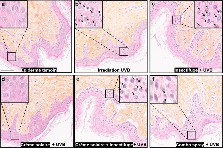 Histometric Analysis of UVB Irradiated Human Skin Biopsies After Application of Sunscreen and Insect Repellent