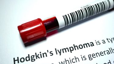 Stanford’s Innovative Blood Test Offers New Hope for Hodgkin Lymphoma Patients