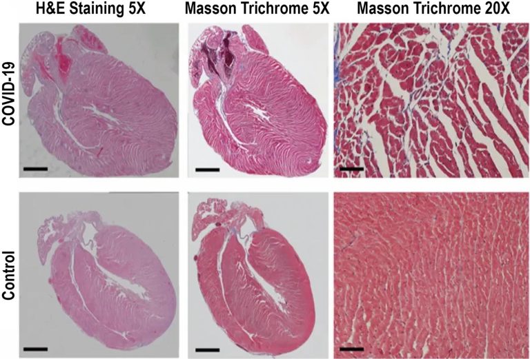 How COVID19 Can Impact the Heart Inflammation, Oxidative Stress and
