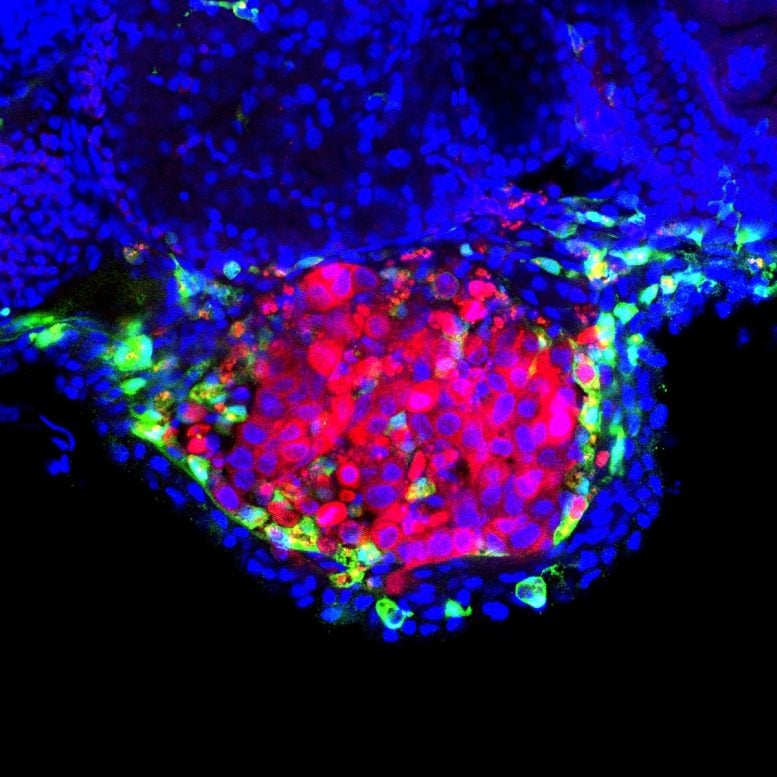 Human Bladder Tumor Surrounded by Zebrafish Macrophages