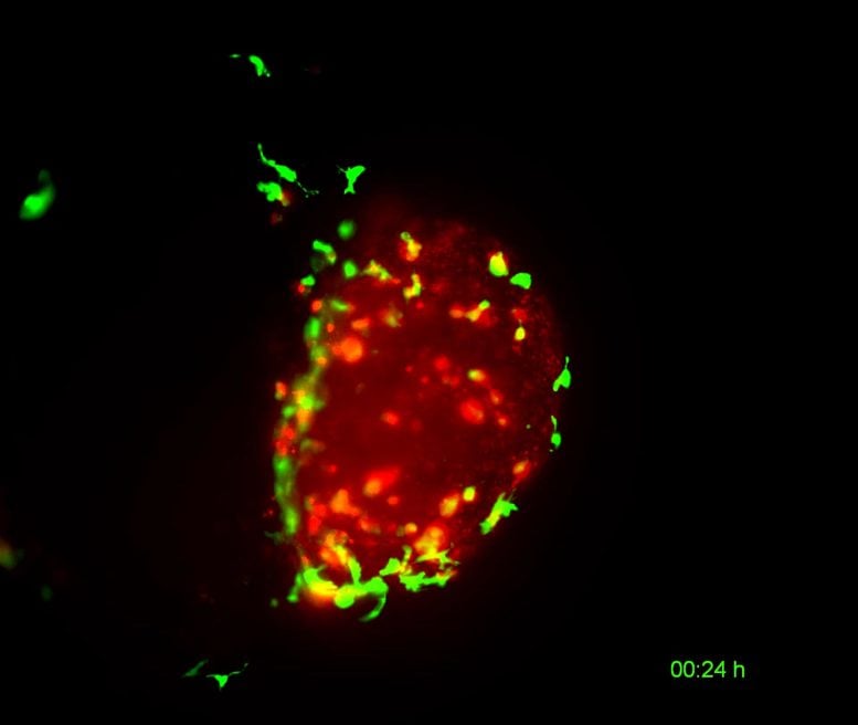 Human Bladder Tumour Being Cleared by Zebrafish Macrophages