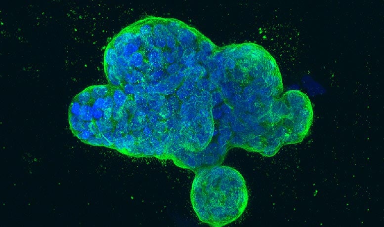Human Breast Cancer Cells