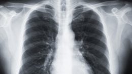 Human Chest X-ray