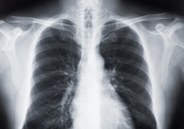 Human Chest X-ray