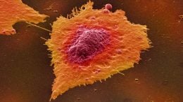 Human Colon Cancer Cells