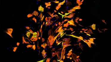 Human Fibroblasts Reprogrammed Into Cardiomyocyte Like Cells