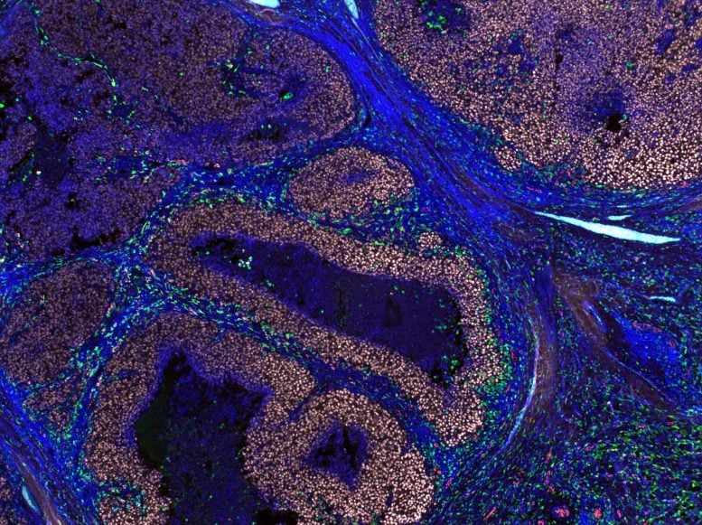 Human Melanoma Tumour