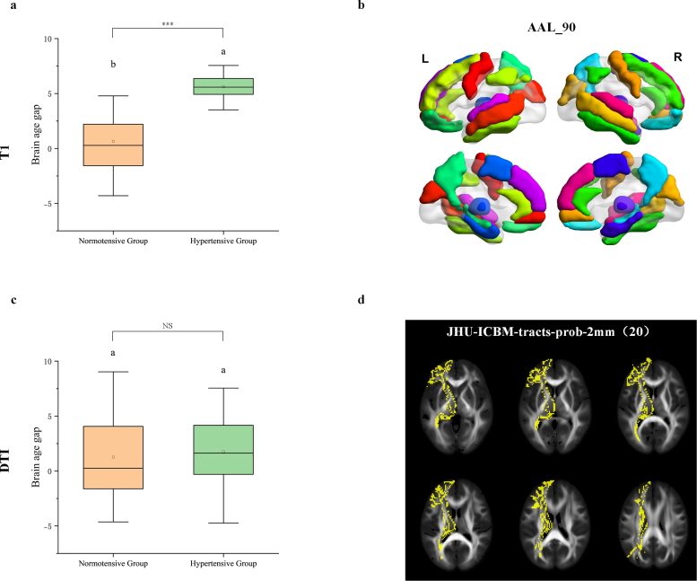 Hypertension Is Linked to Elevated Brain Age Gap in T1 Based Imaging